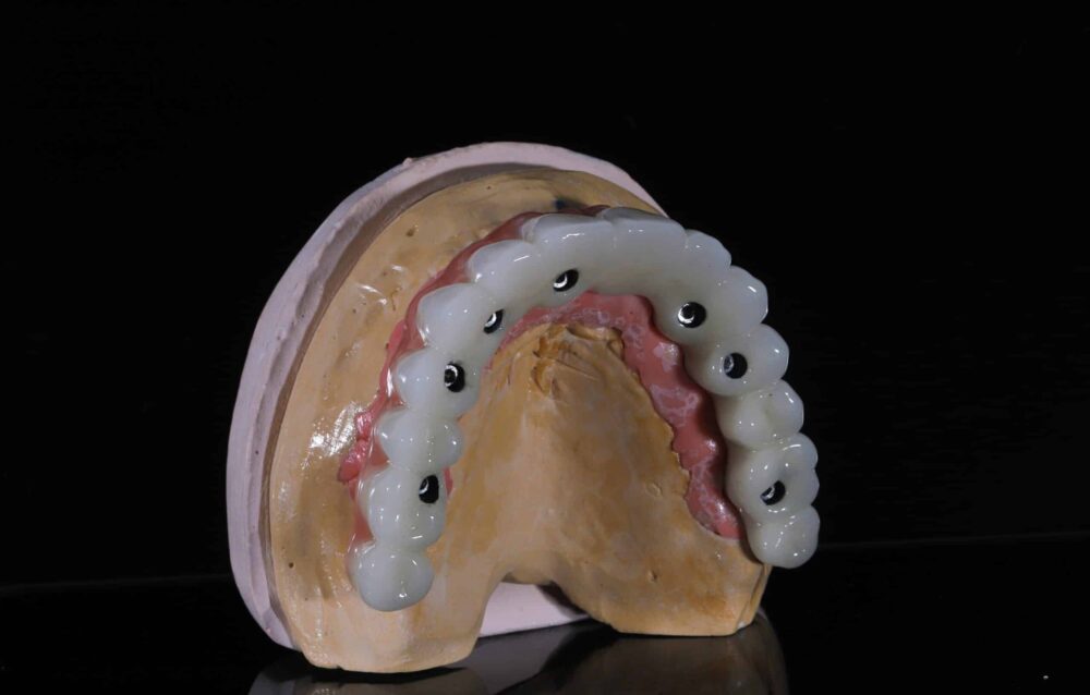 Full Arch Restorations near me